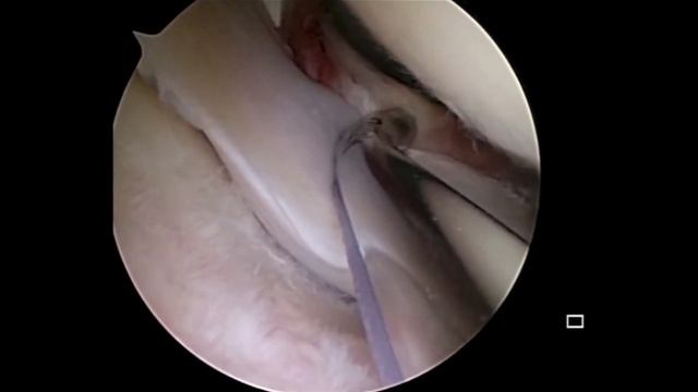 Dr, Daniel Mok : Meniscal Tears: Remove vs. Repair смотреть онлайн