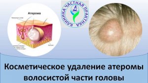 Косметическое удаление атеромы волосистой части головы