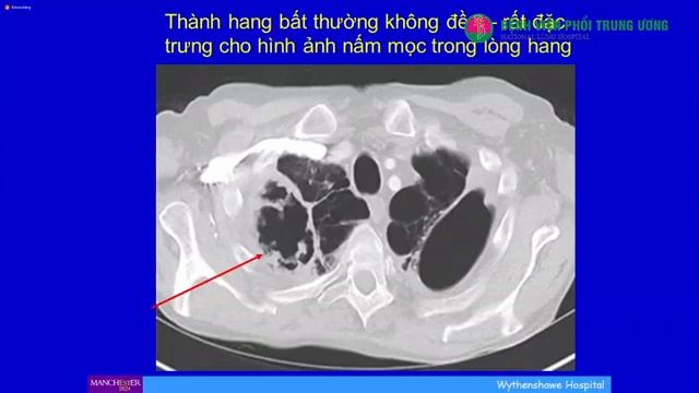 Dịch tễ và chiến lược chẩn đoán Nấm phổi Aspegillus mạn tính | GS. David W Denning смотреть онлайн
