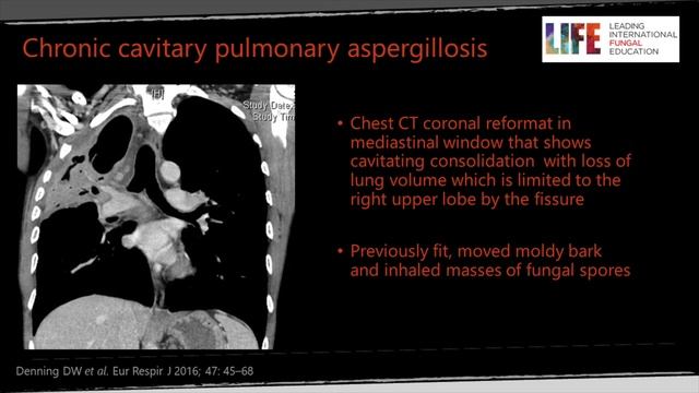 Radiology of chronic pulmonary aspergillosis смотреть онлайн