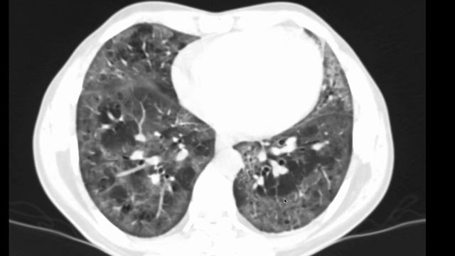 Pneumocystic Jirovecii infection in immunocompromised patient смотреть онлайн