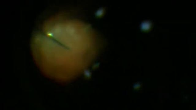 RETINA: Sight Back To Forgotten Eye - Post-Uveitis