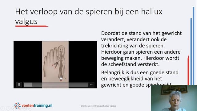 Anatomie van de hallux valgus смотреть онлайн
