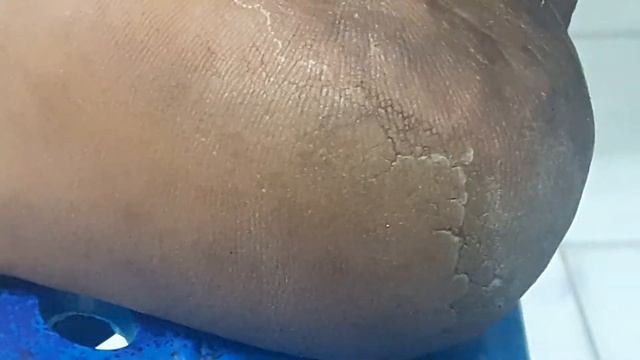 Tinea Pedis after 2 therapies смотреть онлайн