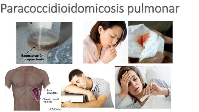 PARACOCCIDIOIDOMICOSIS смотреть онлайн
