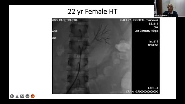 Renal Artery Stenosis Interventions - some issues смотреть онлайн