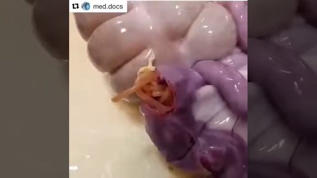 Intestinal obstruction by ascariasis lumbricoids смотреть онлайн