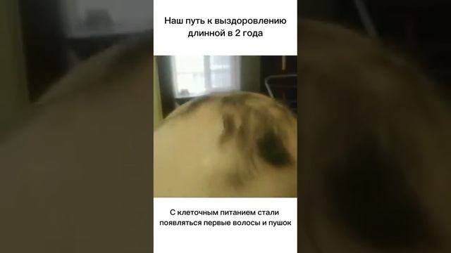 Шикарный результат по алопеции☝️ смотреть онлайн