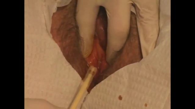 #084 Female Catheterization Technical Procedure | Reviewed By Elsevier | Cheap Ebooks