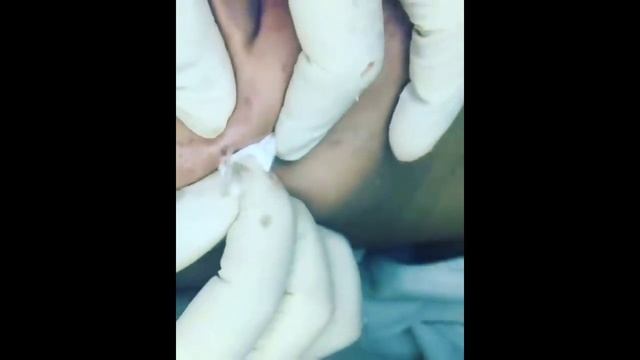 How To Removal Blackhead And How To Get Rid Of Blackhead Blackhead On Face