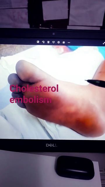 #cholesterolembolismsyndrome#cholesterolembolism CHOLESTEROL EMBOLISM SYNDROME смотреть онлайн