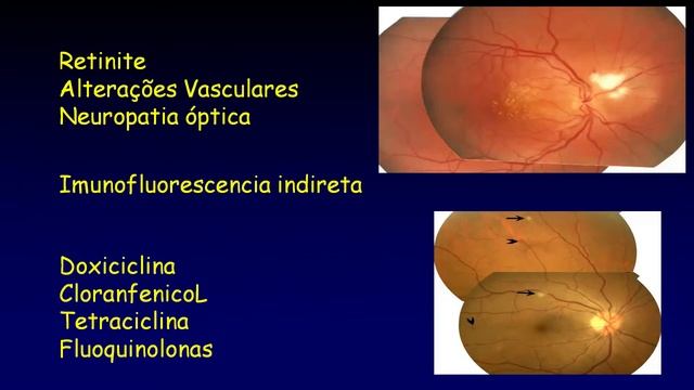 UNIRIO - Uveítes Infecciosas - Dr.  Andre Curi (Fiocruz)