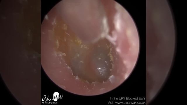 1,110 - Fungal Aspergillus Niger Infection Ear Wax Removal смотреть онлайн