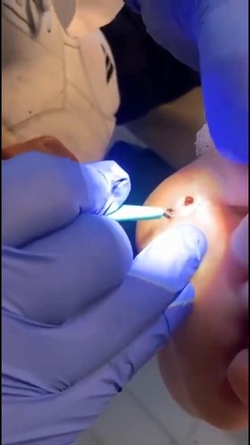 Monster splinter removed from foot смотреть онлайн