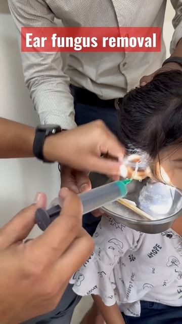 Ear fungus removal смотреть онлайн
