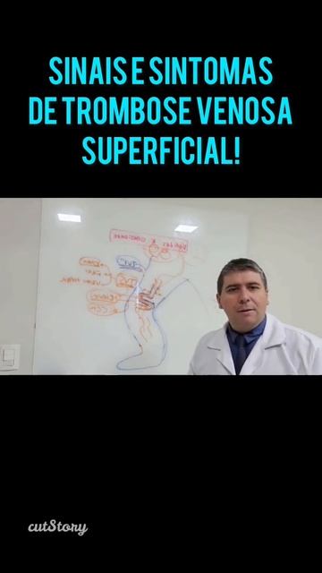 O que é trombose venosa superficial! смотреть онлайн
