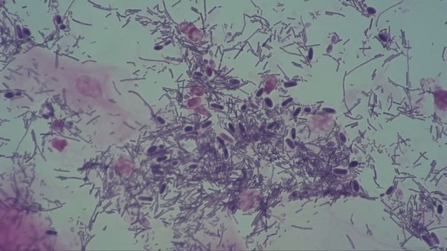 Gynaecology. Bacterial Vaginosis. Candidiasis. Candida Albicans.