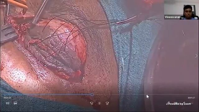 Diagnosis & Management of Fungal Infections - ENT & Pulmonary Prespective смотреть онлайн