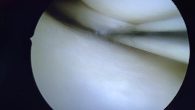 Мениск под шов