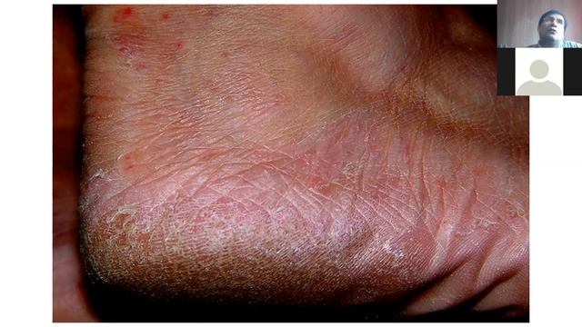 MEDICINA III Micosis superficiales I y II смотреть онлайн