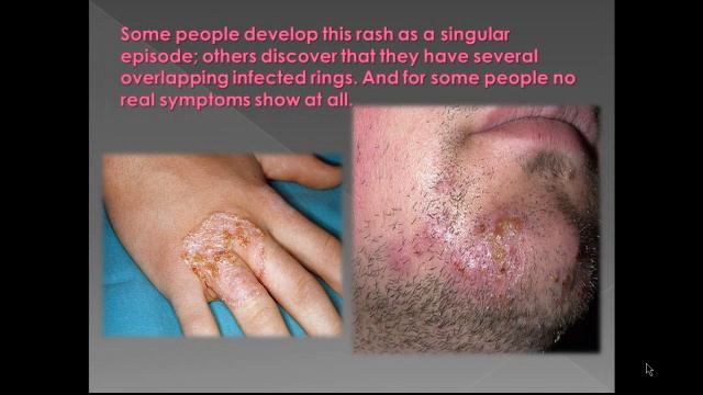 Ringworm Secret #2 смотреть онлайн