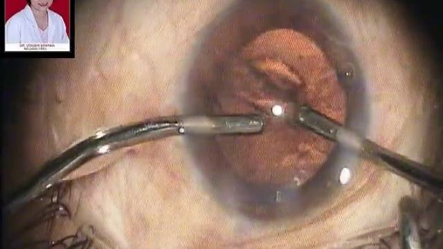 Phacoemulsificaion & IOL Implantation in High Myope SuVi Eye Institute Kota India.mpg смотреть онлайн