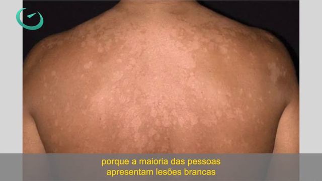 Pano branco, micose de praia? Entenda Ptiríase Versicolor смотреть онлайн