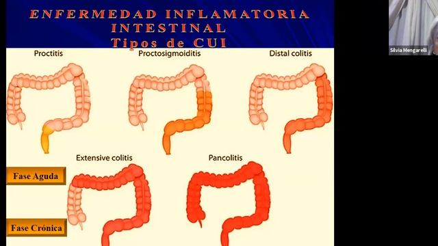 Farmacología De La Enfermedad Inflamatoria Intestinal