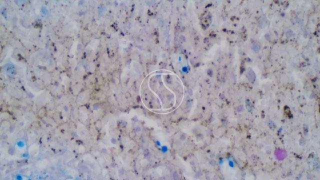 Cryptococcus neoformans under the microscope with Alcian Blue and PAS Stain смотреть онлайн