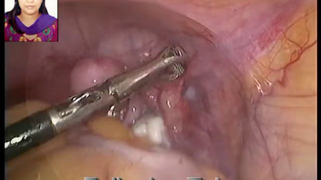 DLH Procedure by Dr. Aruna Khandelwal_Khandelwal Nursing Home , Kota (Rajasthan) India смотреть онлайн