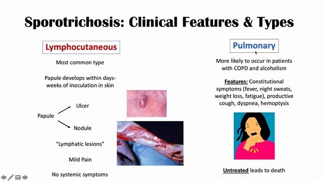 Sporotrichosis (Rose Gardener’s Disease): Causes, Risks, Types, Symptoms, Diagnosis, Treatment смотреть онлайн