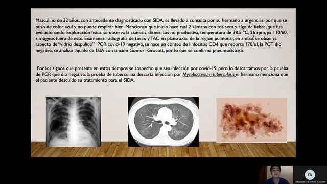 PIA (Pneumocystis Jirovecii)