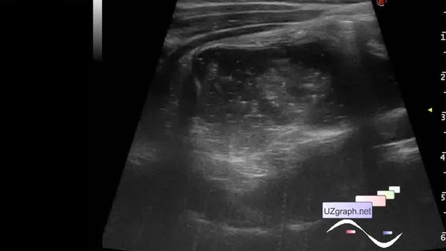 Pediatric Abdominal ultrasound - Giant progressive intestinal intussusception in a schoolchild смотреть онлайн