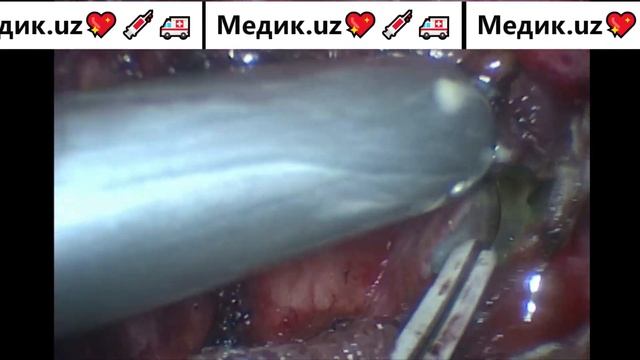 Эхинококк малого таза #эхинококк #печень #киста #операция #эхинококкоз смотреть онлайн