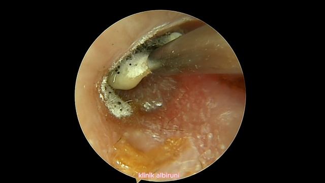 Aspergillus Niger Sits On Eardrum смотреть онлайн