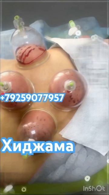 #седалищныйнерв болит #занхо смотреть онлайн