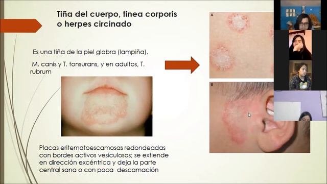 Micosis cutaneas y dermatofitas смотреть онлайн