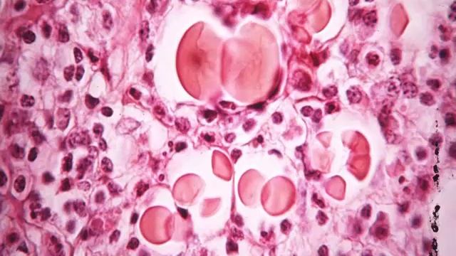 Clinical Mycology: Direct Examination Series: Uncommon Organisms [Hot Topic]