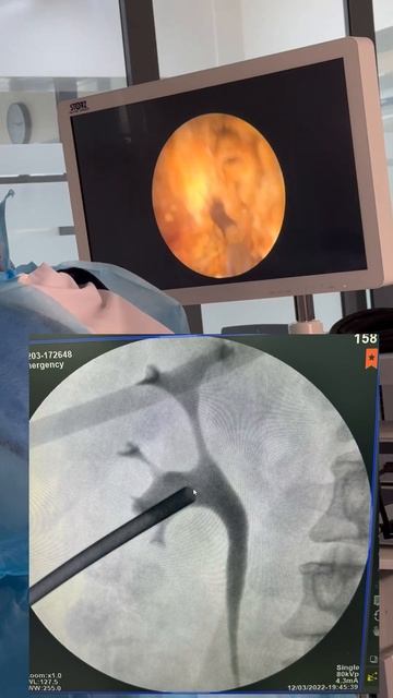 Эндоуролог. Лазерная удаления камень в почках. смотреть онлайн