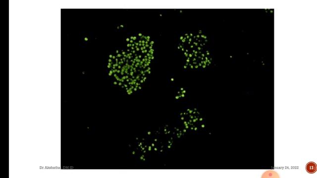 Opportunistic infections in HIV| Pneumocystis pneumonia| PCP | AIIMS Recall| AIIMS MCQ based смотреть онлайн