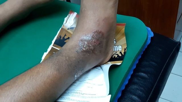 One side eczema suspect fungus. Note geographical borders. Tinea Corporis смотреть онлайн