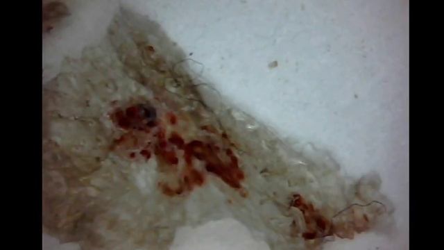 Morgellons Is Aspergillus Fumigatus - Shingels, Fibromyalgia, Lymes Disease -Morgellons A Pandemic