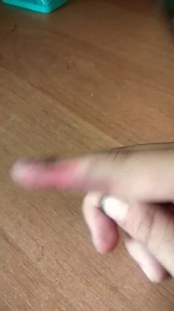 Что делать при ожоге серной кислоты смотреть онлайн