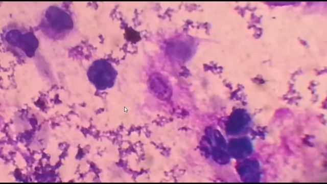 Pneumocystis Pneumonia :causative Agent, Lab Diagnosis And Treatment