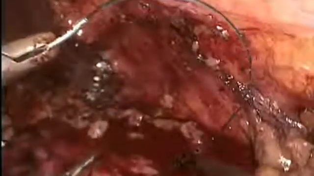 Laparoscopic partial nephrectomy (selective arterial clamp) смотреть онлайн