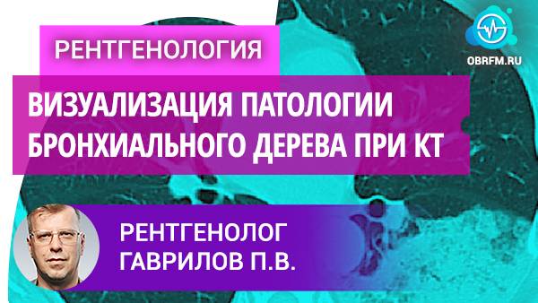 Рентгенолог Гаврилов П.В.: Визуализация патологии бронхиального дерева при компьютерной томографии смотреть онлайн