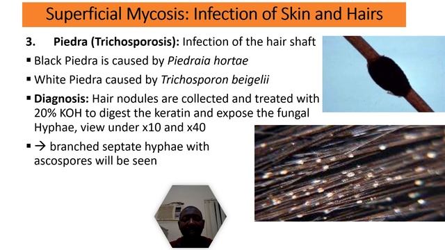 Mycosis -An Overview Of Fungal Infections