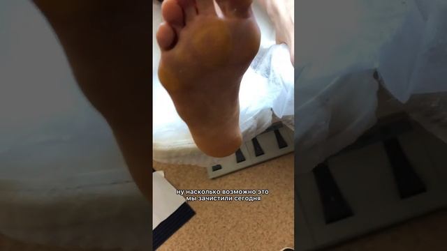 Грибок ногтей. Часть 2 - после зачистки. #подология #медицина #грибокногтей смотреть онлайн