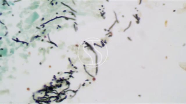 Candida Under The Microscope With Gomori's Methenamine Silver (GMS) Stain