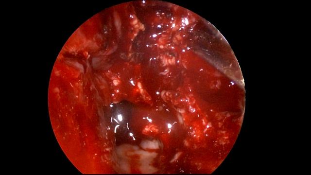 VIDIAN Nerve Invasion | MUCOR affecting Sphenopalatine artery & Maxillary Artery смотреть онлайн